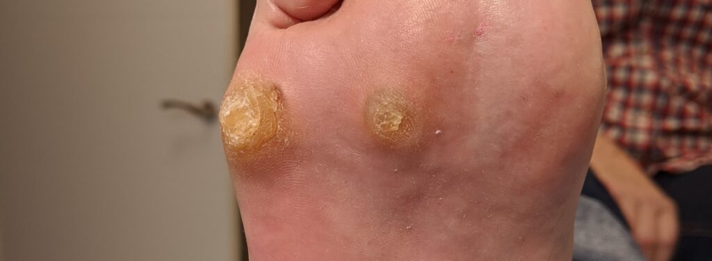 ¿Sabías que fumar y tener callos en los pies está relacionado?