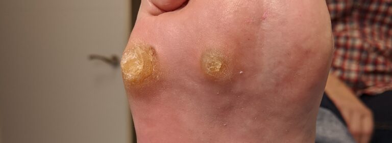 ¿Sabías que fumar y tener callos en los pies está relacionado?